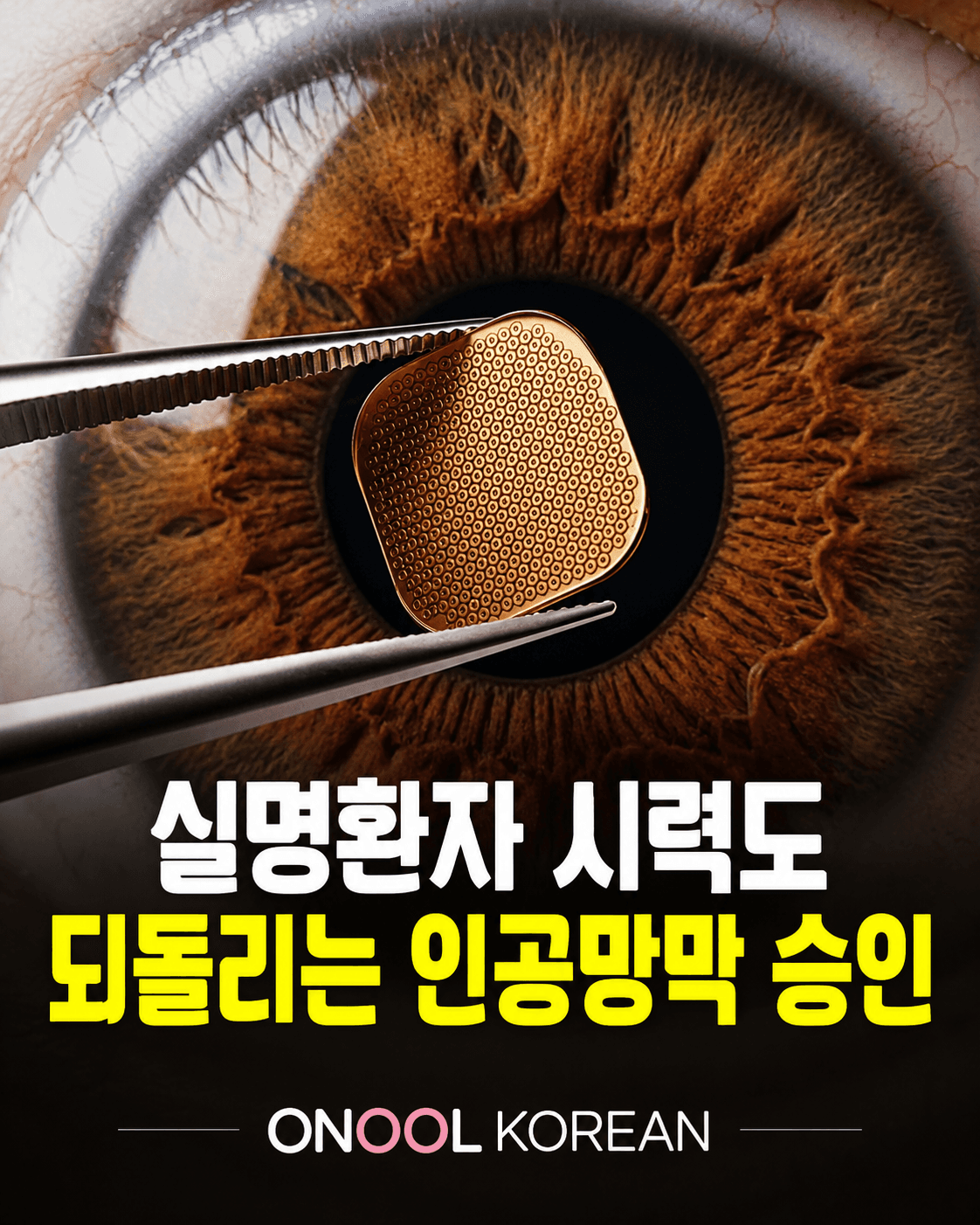 공 망막 칩으로 다시 글을 읽는다… 美 스타트업 ‘프리마’, 유럽 판매 허가
